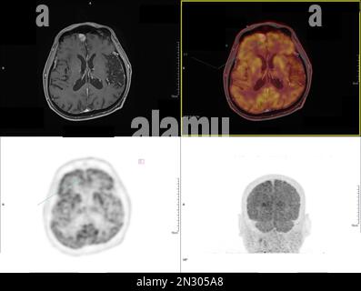 Positron emission tomography (PET) CT scan uses a radioactive drug (tracer) to show both normal and abnormal metabolic activity of Whole  human body Stock Photo