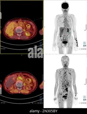 Positron emission tomography (PET) CT scan uses a radioactive drug (tracer) to show both normal and abnormal metabolic activity of Whole  human body Stock Photo