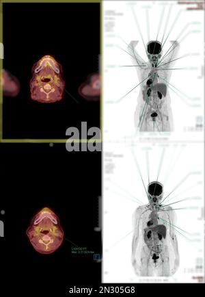 Positron emission tomography (PET) CT scan uses a radioactive drug (tracer) to show both normal and abnormal metabolic activity of Whole  human body Stock Photo