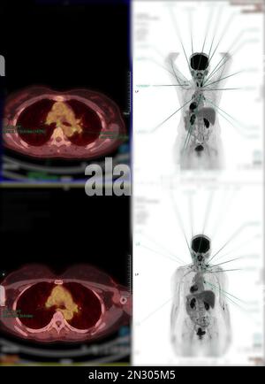 Positron emission tomography (PET) CT scan uses a radioactive drug (tracer) to show both normal and abnormal metabolic activity of Whole  human body Stock Photo