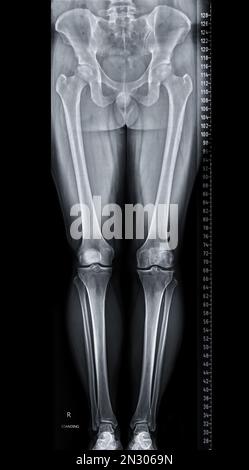 Scanogram is a Full-length standing AP radiograph of both lower extremities including the hip, knee, and ankle. Stock Photo