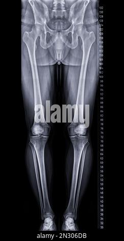 Scanogram is a Full-length standing AP radiograph of both lower extremities including the hip, knee, and ankle. Stock Photo