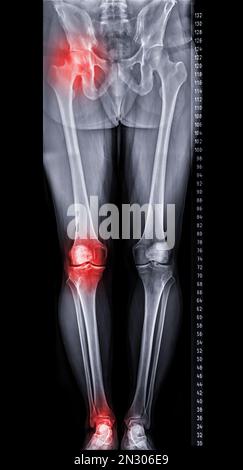 Scanogram is a Full-length standing AP radiograph of both lower extremities including the hip, knee, and ankle. Stock Photo