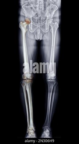 Scanogram is a Full-length standing AP radiograph of both lower extremities including the hip, knee, and ankle with 3D rendering. Stock Photo