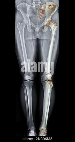 Scanogram is a Full-length standing AP radiograph of both lower extremities including the hip, knee, and ankle with 3D rendering. Stock Photo