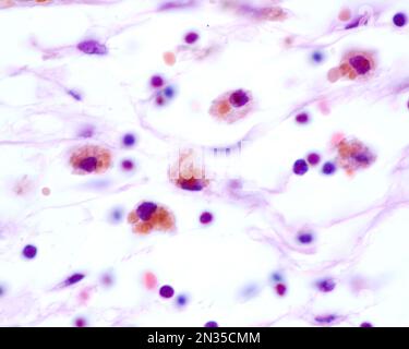 Macrophages showing large brown inclusions originated by phagocytosis ...