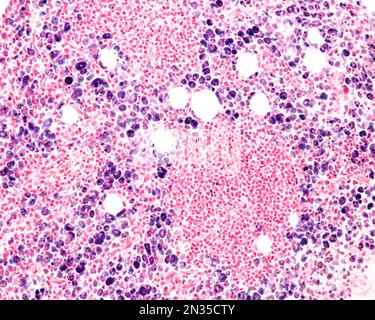 Macrophages of an inflammation zone heavily marked with Trypan blue a vital stain that can be introduced in the body. Circulating Trypan blue is phago Stock Photo