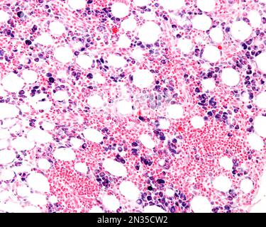 Macrophages of an inflammation zone heavily marked with Trypan blue a vital stain that can be introduced in the body. Circulating Trypan blue is phago Stock Photo