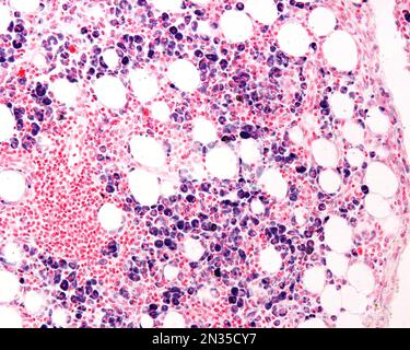 Macrophages of an inflammation zone heavily marked with Trypan blue a vital stain that can be introduced in the body. Circulating Trypan blue is phago Stock Photo