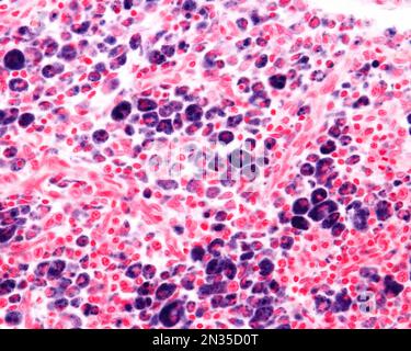 Macrophages of an inflammation zone heavily marked with Trypan blue a vital stain that can be introduced in the body. Circulating Trypan blue is phago Stock Photo