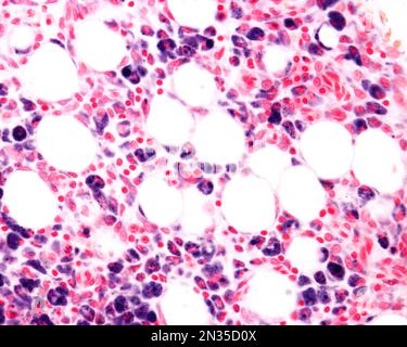 Macrophages of an inflammation zone heavily marked with Trypan blue a vital stain that can be introduced in the body. Circulating Trypan blue is phago Stock Photo