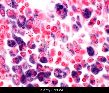 High magnification micrograph showing macrophages of an inflammation zone heavily marked with Trypan blue. Trypan blue is a vital stain that can be in Stock Photo