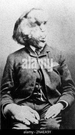 Joseph Merrick, the Elephant Man. Portrait of Joseph Carey Merrick (1862-1890) who had severe physical deformities, c. 1889 Stock Photo