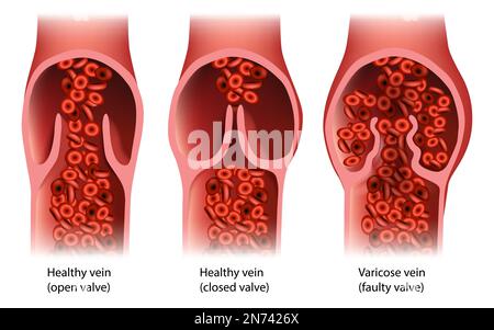 Chronic Venous Insufficiency or venous reflux.Venous Disease Varicose vein Faulty valve. Healthy vein Stock Vector