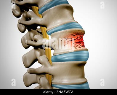 Lumbar Compression Fracture Stock Photo - Alamy