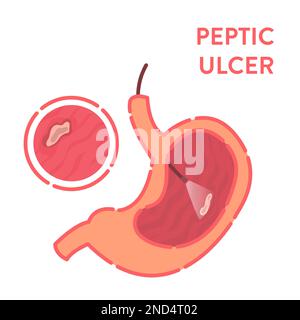 Peptic Ulcer Disease Infographic illustration Stock Vector Image & Art ...