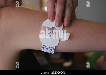 Applying the sticker for the blood glucose sensor Stock Photo