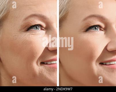 Collage with photos of mature woman before and after biorevitalization