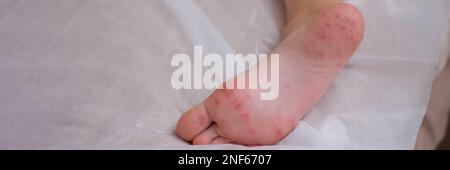 Child foot with red itchy rash closeup Stock Photo