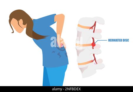 Vector of a young woman with a low back pain and sciatica from a herniated disc. Stock Vector