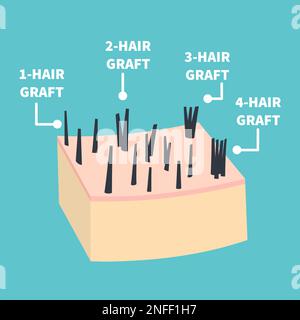 Hair graft types set for hair transplantation Stock Vector