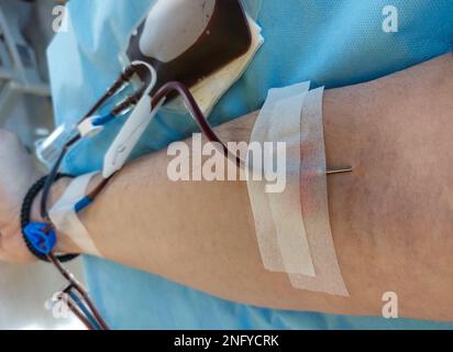 blood donor with big needle stuck in forearm during donation at hospital Stock Photo