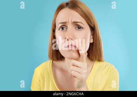 Upset woman with herpes applying cream on lips against light blue background Stock Photo