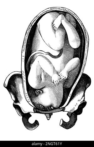 Abnormal position of the fetus. Face presentation. Antique illustration from a medical book. 1889. Stock Photo