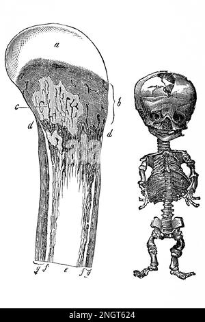 Rickets. Influence of a poor diet during childhood. Antique illustration from a medical book. 1889. Stock Photo