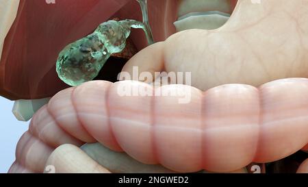 Gallstones in the gallbladderand bile duct, human silhouette and anatomy of surrounding organs, liver and gallbladder with stones, Realistic 3D Render Stock Photo