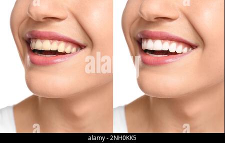 Collage with photos of woman before and after teeth whitening, closeup Stock Photo