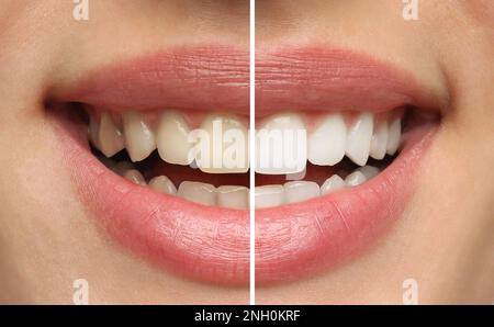 Collage with photos of woman before and after teeth whitening, closeup Stock Photo