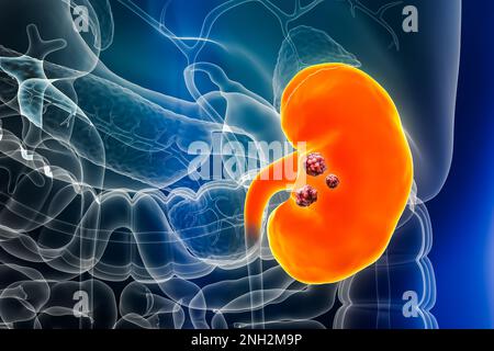 Kidney or renal pelvis cancer with organs and tumors or cancerous cells 3D rendering illustration. Anatomy, oncology, biomedical, nephrology, disease, Stock Photo