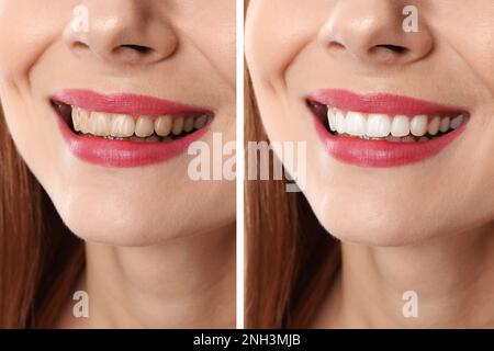 Collage with photos of woman before and after teeth whitening, closeup Stock Photo