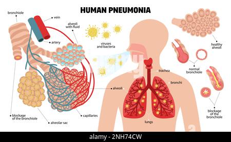 Human pneumonia set of infographic elements with anatomical scheme of respiratory system essentials with text captions vector illustration Stock Vector