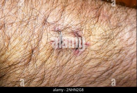 Surgical staples for sutures to close the skin Stock Photo - Alamy