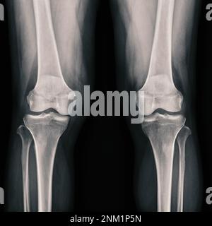 Film x-ray  both knee joint  AP view showing normal knee joint. Stock Photo
