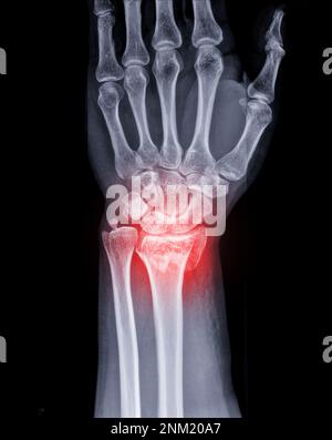 X-ray image of Left wrist joint AP and Lateral view for showing fracture of radius bone. Stock Photo