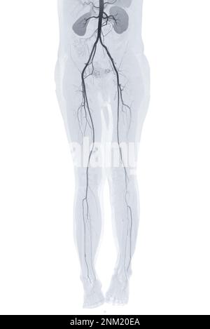 CTA femoral artery run off showing femoral artery  Presenting with Acute or Chronic Peripheral Arterial Disease. Stock Photo