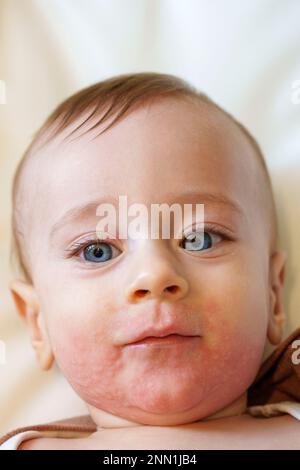 baby allergy skin. child dermatitis symptom problem rash. suffering ...