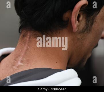Bensheim, Germany. 10th Feb, 2023. A war refugee from Syria shows the scar on his neck on the grounds of the refugee shelter. Cities and communities can hardly accommodate the number of refugees. The Bergstrasse district is not alone in calling for more support from the federal and state governments. Credit: Arne Dedert/dpa/Alamy Live News Stock Photo