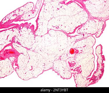 Very low magnification light microscope micrograph of white adipose tissue or fat, stained with hematoxylin and eosin. Adipocytes (fat cells) contain Stock Photo