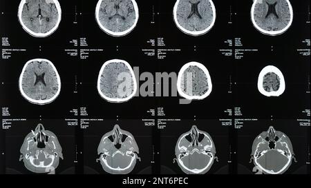 Magnetic resonance imaging of the brain from different sides, traumatic ...