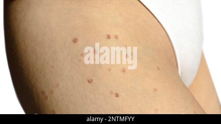 burns from laser hair removal. Burn spots from laser skin treatment for body hair removal. burns. High quality photo Stock Photo