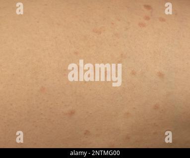 burns from laser hair removal. Burn spots from laser skin treatment for body hair removal. burns. High quality photo Stock Photo