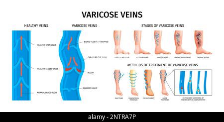 Varicose veins realistic infographics  vector illustration with stages of illness scheme of damaged and healthy valves and methods of treatment Stock Vector