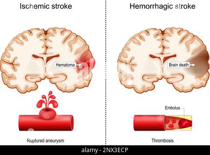 Hemorrhagic and Ischemic strokes. Cross sections of human brain with Hematoma and part of Brain death.  close-up of blood vessel Stock Vector