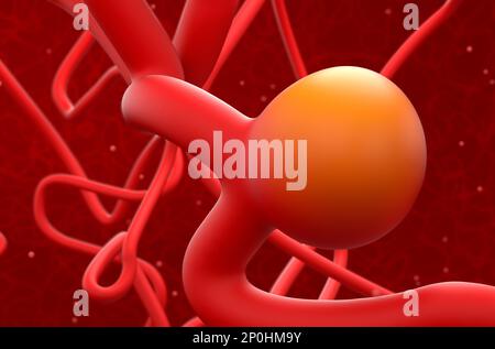 Brain artery aneurysm (Cerebral Aneurysm) - 3d illustration closeup view Stock Photo