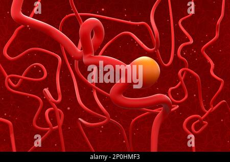 Brain artery aneurysm (Cerebral Aneurysm) - 3d illustration isometric view Stock Photo