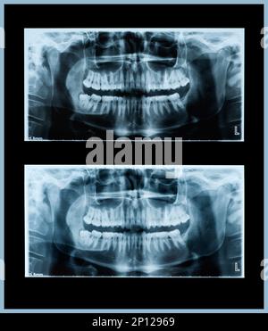 Panoramic dental x-ray image of teeth and mouth Stock Photo